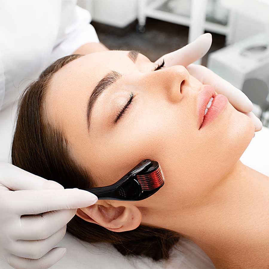 microneedling